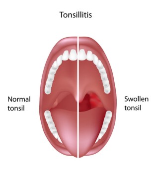 Intracapsular Tonsillectomy by OrangeCountySurgeons